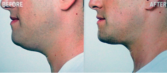 Double Chin Treatment - Belkyra / Kybella - patient 001 - side