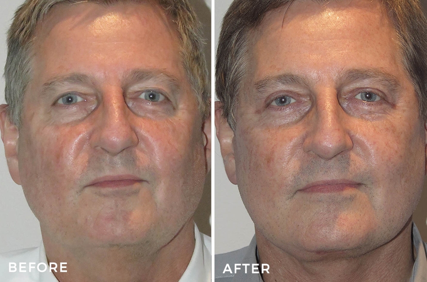 Neck Lift + Face Lift + Upper Eyelid Surgery