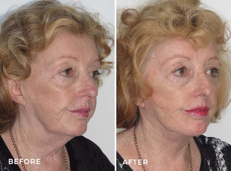 Patient 13: Revision Facelift and necklift  Before And After