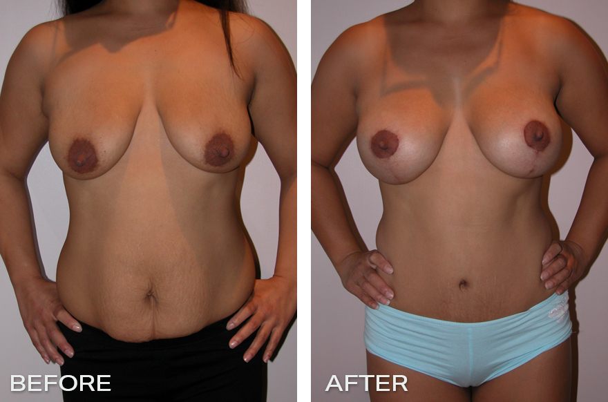 Breast Lift Surgery Front - Dr Jeremy Hunt