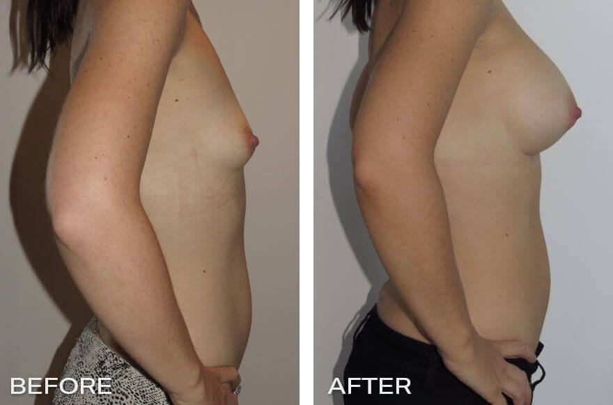 Before and After Front - Case Study of Breast Enlargement Dr Jeremy Hunt
