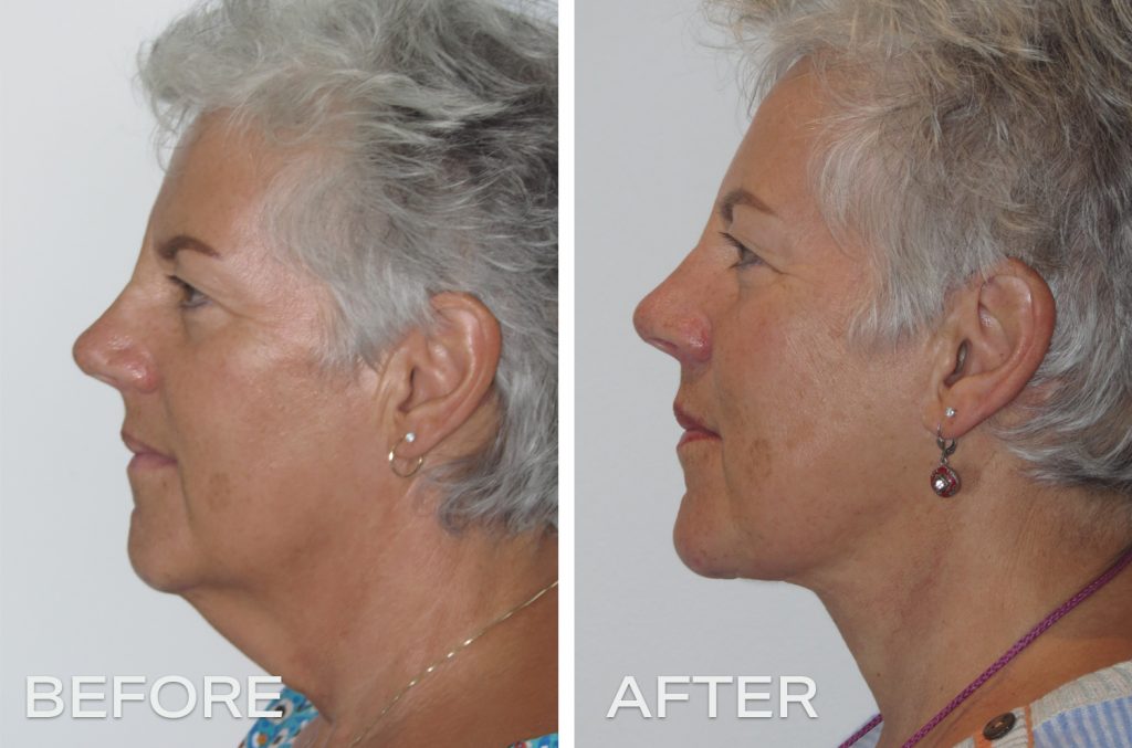 female neck lift before and after - Dr Jeremy Hunt Leading Plastic Surgeon Sydney NSW