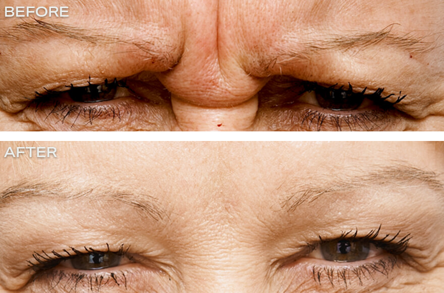 Anti wrinkle Injections 