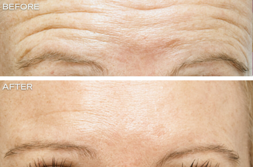 Anti wrinkle Injections 