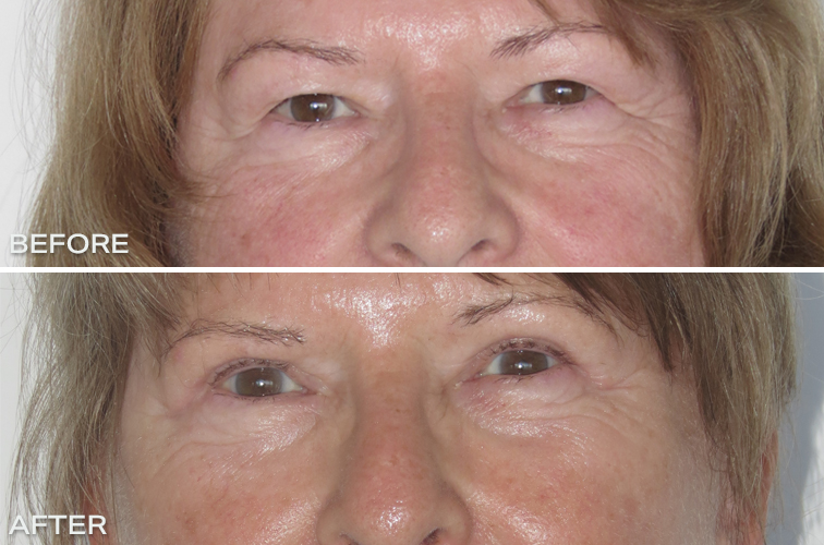 Eyelid Surgery – Upper Blepharoplasty Before and After Photos Australia