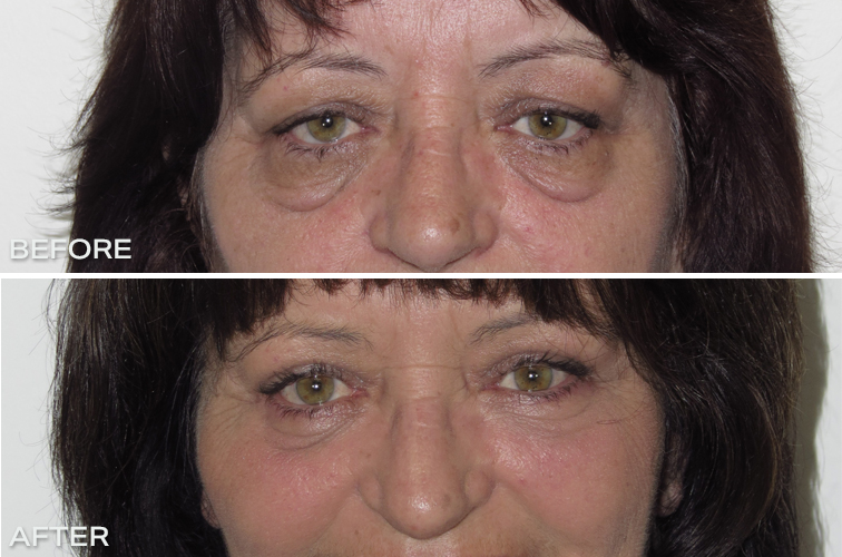 Eyelid Surgery – Upper and Lower Blepharoplasty Before and After Australia