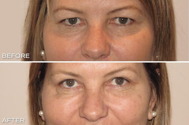 Fixing Hooded Eyelids Before and After Dr Hunt Sydney