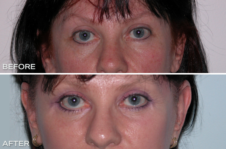 Eyelid Surgery - Lower Blepharoplasty Before and After Photos Sydney