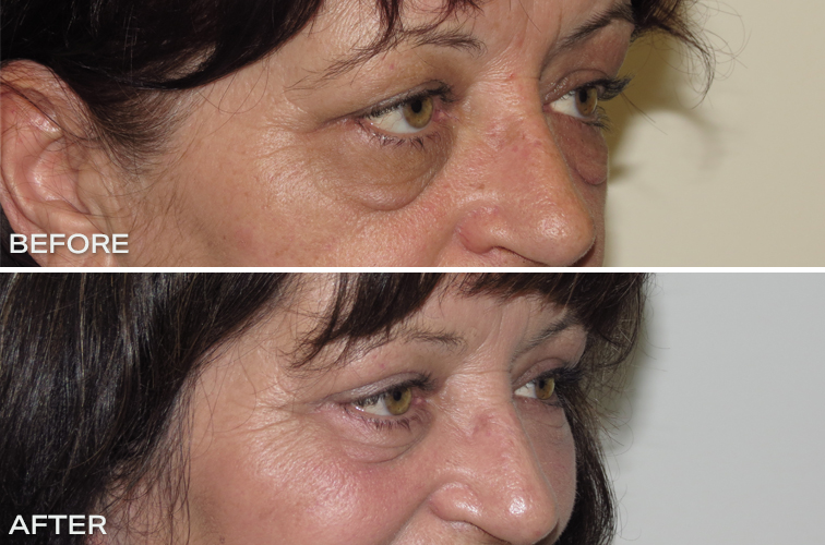 Upper and Lower Blepharoplasty Before and After Australia