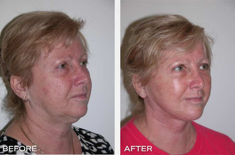 Patient 15: Results Following A Facelift and necklift Surgery