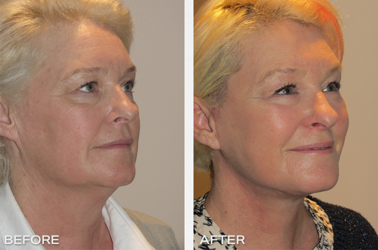 Patient 16: Facelift and necklift Before And After, Sydney
