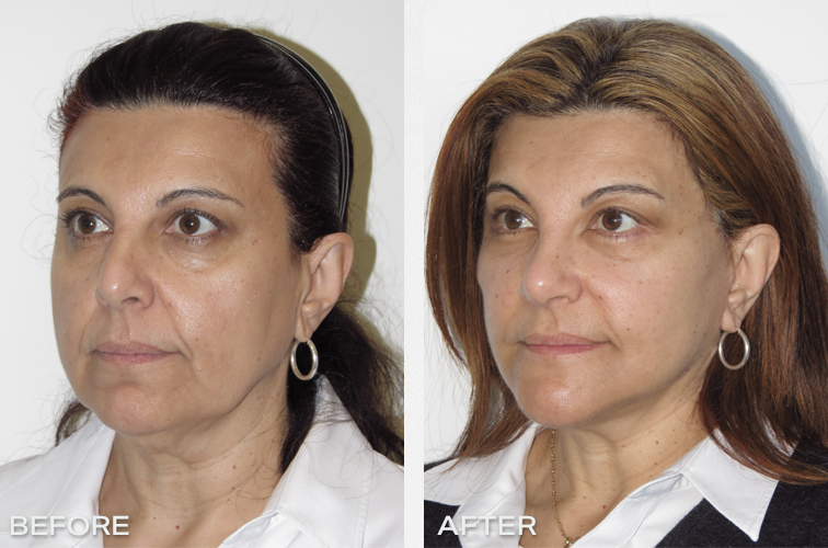 Patient 17: Before and after Facelift and necklift with genioplasty ( chin advancement ) Surgery Before And After Results