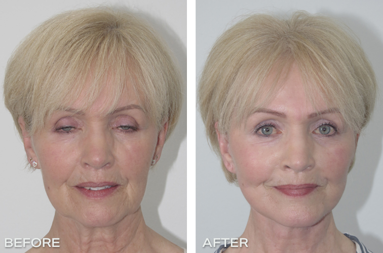 Facelift Before And After