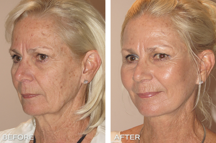 Patient 10: Facelift and necklift and fat grafting  Before And After