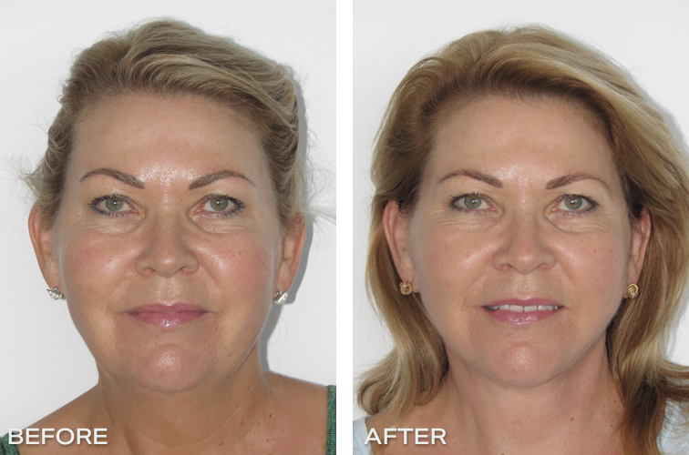 Facelift Before And After