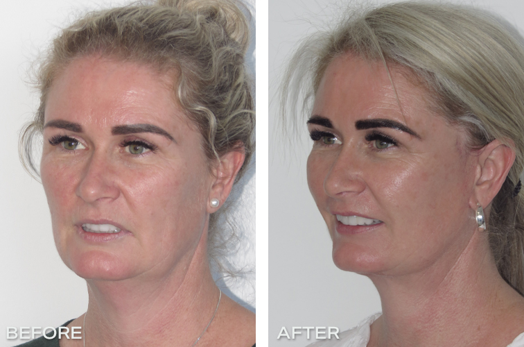 Patient 18: Before And After Facelift and necklift mages