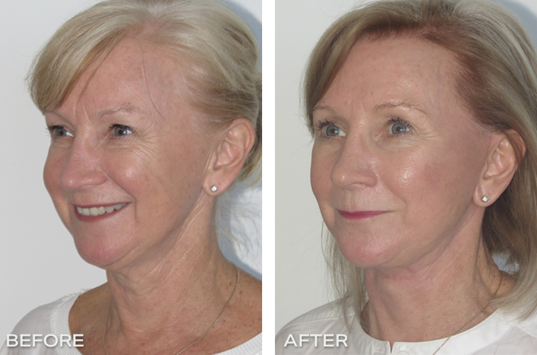 Patient 19: Results Before and After Facelift and necklift and upper blepharoplasty (upper eyelid reduction) Photos