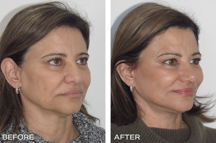 Patient 20: Results Before And After A lower Face lift