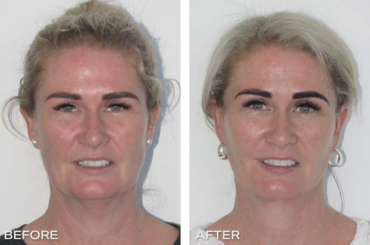 Mini Face Lift Sydney