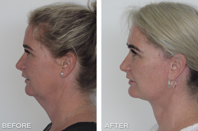 Mini Face Lift Sydney