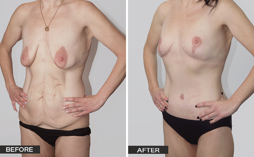 Breast Lift with Implants Before and After - Dr Jeremy Hunt