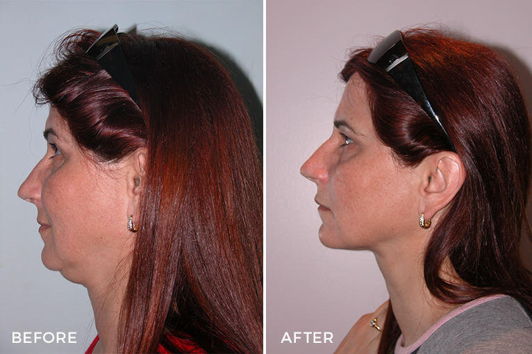 Neck Liposuction Before and After by Dr Jeremy Hunt - Case Study of Heavy Neck