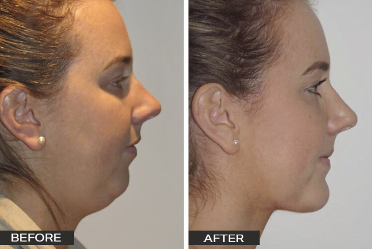 Chin Surgery Case Studies Dr Jeremy Hunt - Chin_2_Side-e1590625600885_edited