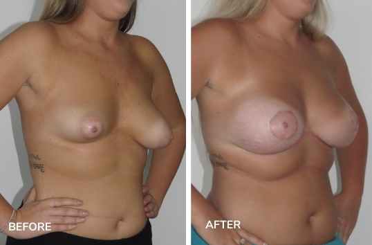 Tuberous Breast Correction SIDE - Dr Jeremy Hunt plastic Surgeon Sydney