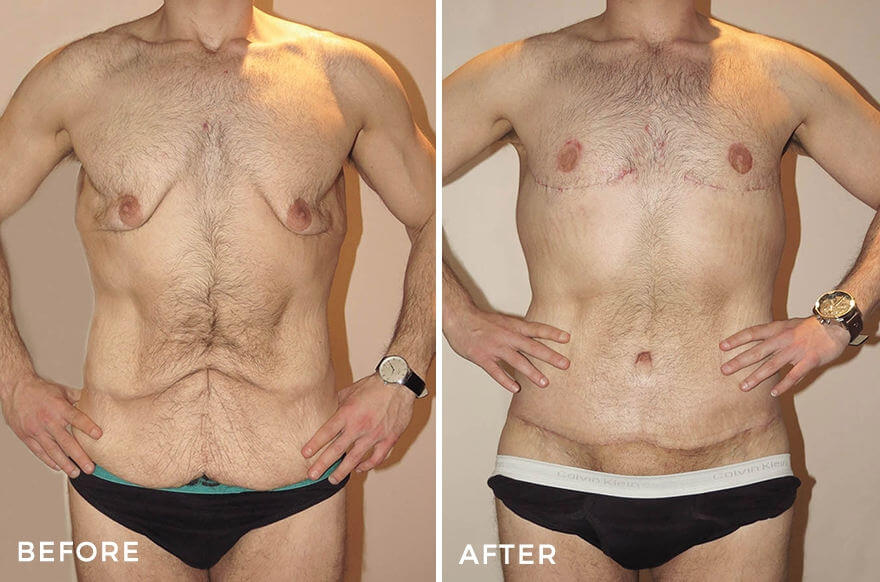 Lower Body Lift + Liposuction + Chest Surgery