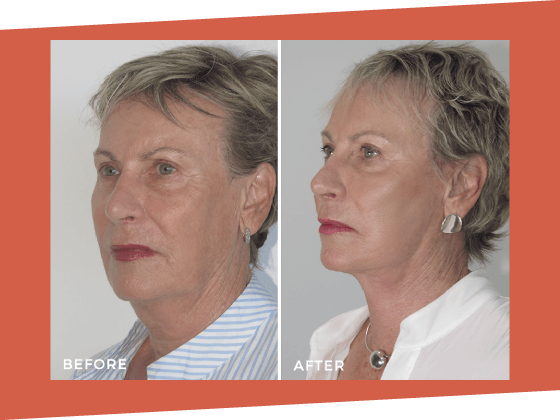 Facelift Dr Jeremy Hunt Before and After Photo - Facelift BA 5 Scaled