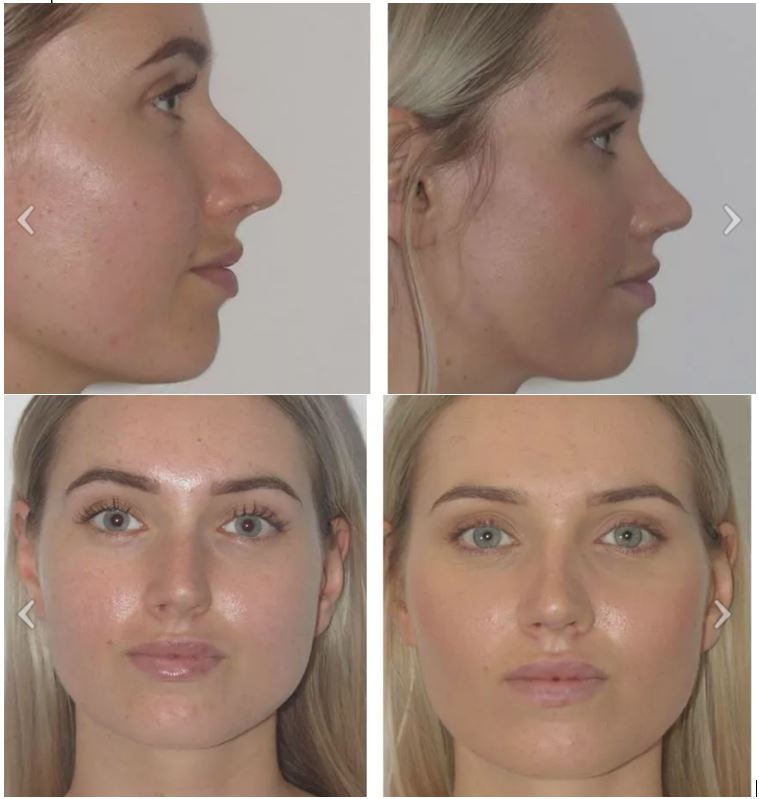 different Types of Noses - Redecution Rhinoplasty - Dr Jeremy Hunt Leading face surgeon
