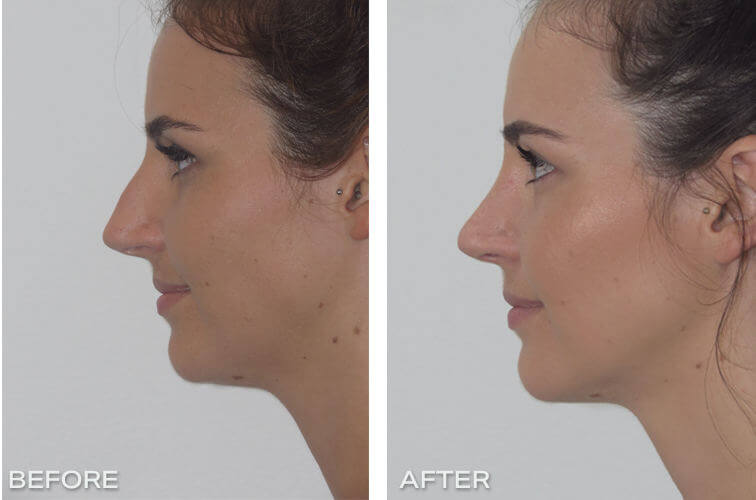 Rhinoplasty Dr Jeremy Hunt Before and After Image - Rhino-side-40 Scaled
