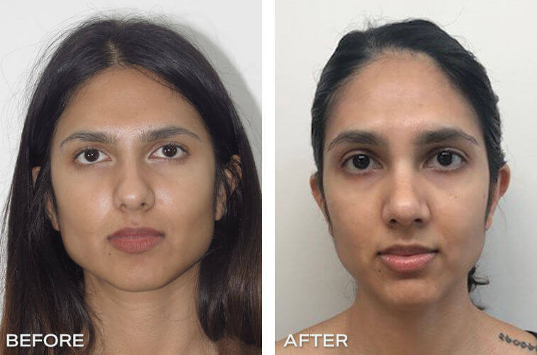 Rhinoplasty Dr Jeremy Hunt Before and After Image - rhino-front-35 Scaled