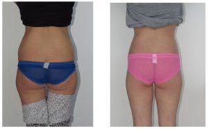 Body Lift Patient With Buttock Augmentation Flap Sydney Dr Hunt