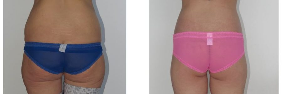 Butt Augmentation for Post Weight Loss Patients