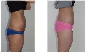 Body Lif with Butt Augmentation Dr Hunt
