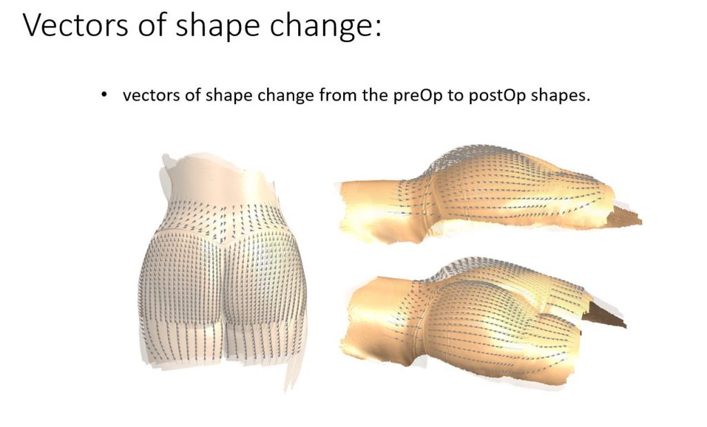 butt augmentation flap surgery Vector Illustration