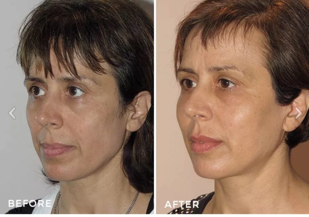 Midface lift with fat transfer Before and After Image Sydney