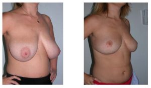 internal bra - how is it performed - Dr Hunt