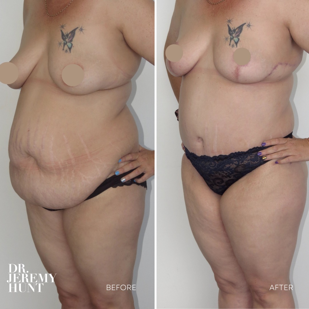 Breast Reduction Before and After Photos - Dr Jeremy Hunt 42-Year-Old Patient and Mum Extended Breast Reduction, Bra Line Lift and Lower Body Lift