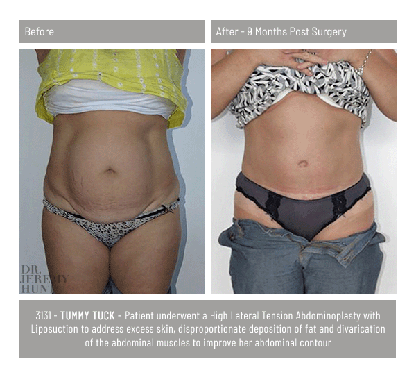 3131_front_tummy tuck_dr jeremy hunt