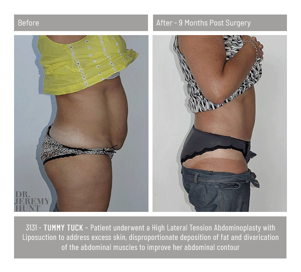 3131_side_tummy tuck_dr jeremy hunt