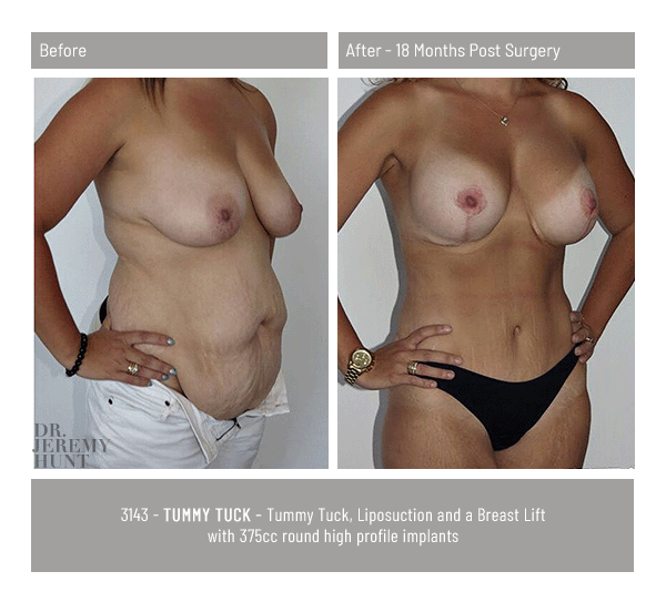 3143_45_tummy tuck_dr jeremy hunt