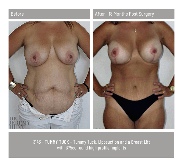 3143_front_tummy tuck_dr jeremy hunt