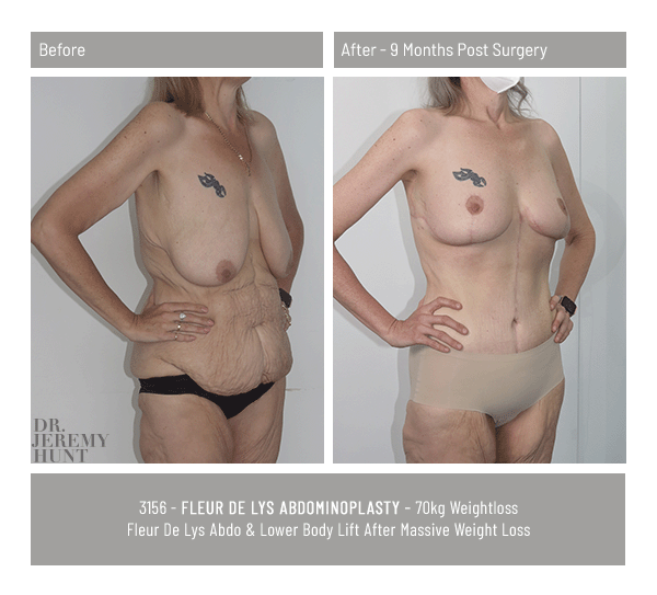3156_45_fleur de lys abdominoplasty_dr jeremy hunt