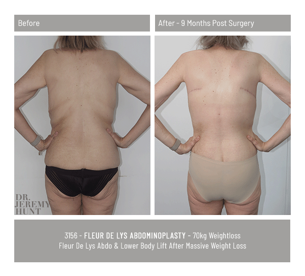3156_back_fleur de lys abdominoplasty_dr jeremy hunt
