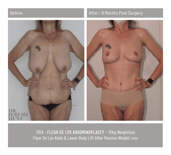 3156_front_fleur de lys abdominoplasty_dr jeremy hunt