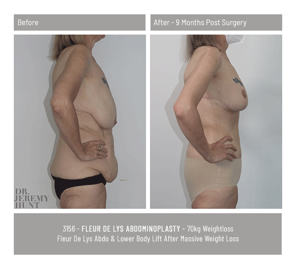 3156_side_fleur de lys abdominoplasty_dr jeremy hunt